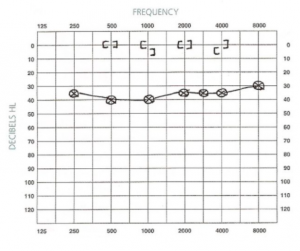 Types of Hearing Loss and Corresponding Audiograms - AZ Hearing