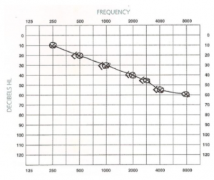 Types of Hearing Loss and Corresponding Audiograms - AZ Hearing